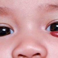 Storchenbiss und Blutschwamm (Hämangiom) beim Baby
