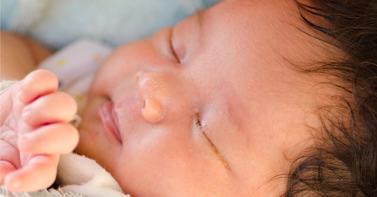 Baby mit verklebten Augen