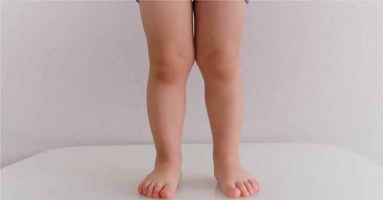 O-Beine und X-Beine beim Baby - Baby.at