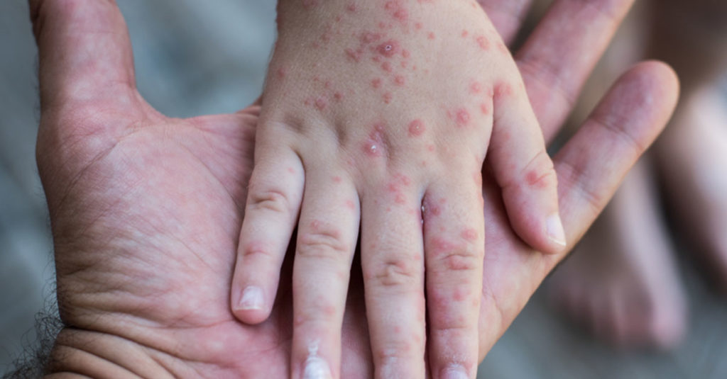 Hand-Fuß-Mund bei Kleinkindern