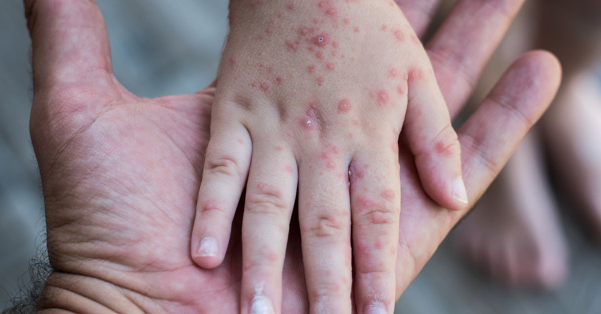 hand-fu-mund-bei-kleinkindern-baby-at