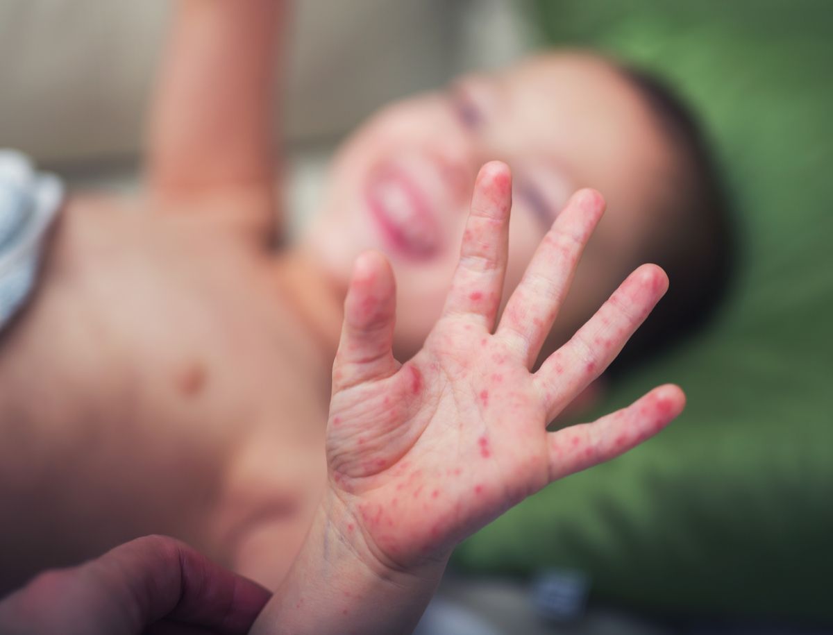 Hand eines Kleinkindes mit Hand-Fuß-Mund