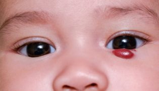 Storchenbiss und Blutschwamm (Hämangiom) beim Baby