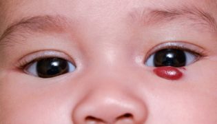 Storchenbiss und Blutschwamm (Hämangiom) beim Baby