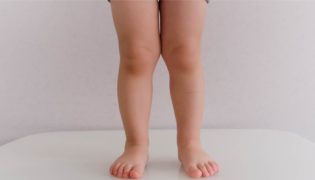O-Beine und X-Beine beim Baby